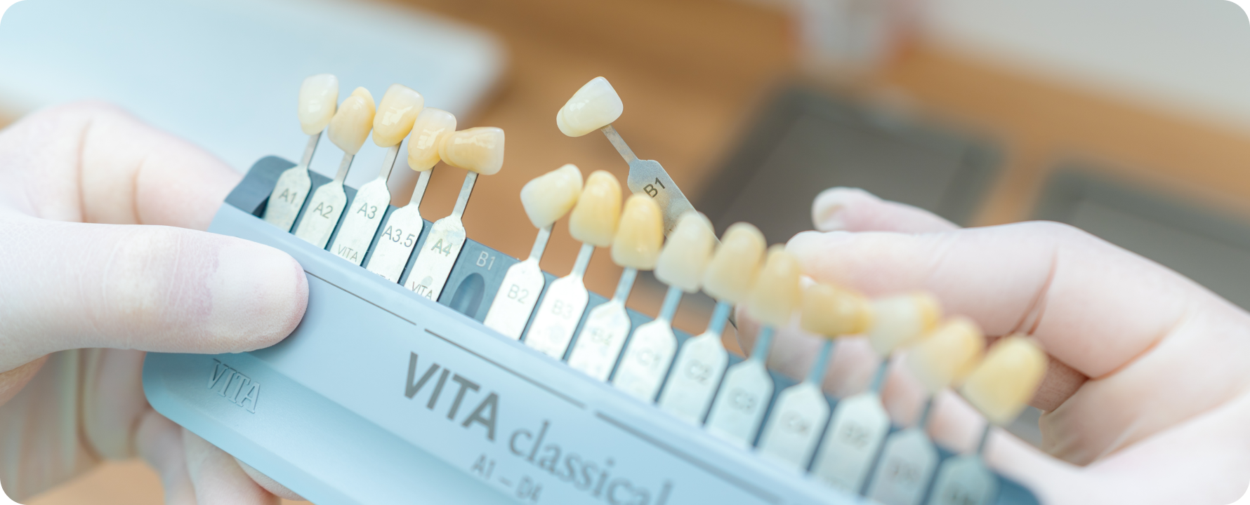 Facettes dentaires à Carnac Immersion dentaire, Dentiste à Carnac