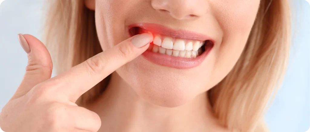 Soins des gencives (parodontologie) Immersion dentaire, Dentiste à Carnac