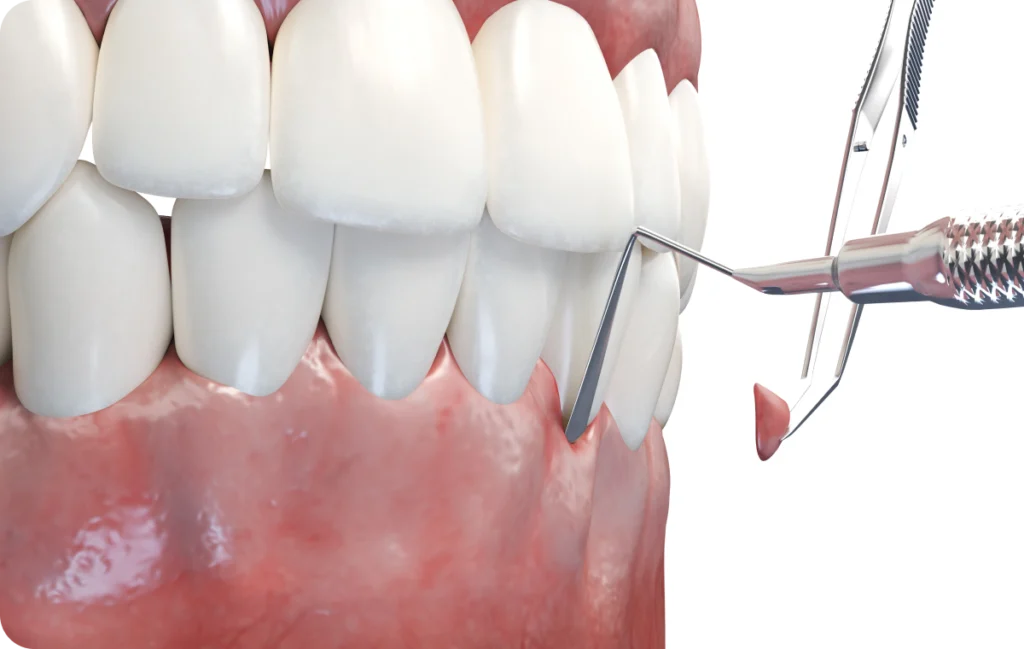 Greffe gingivale Immersion dentaire, Dentiste à Carnac