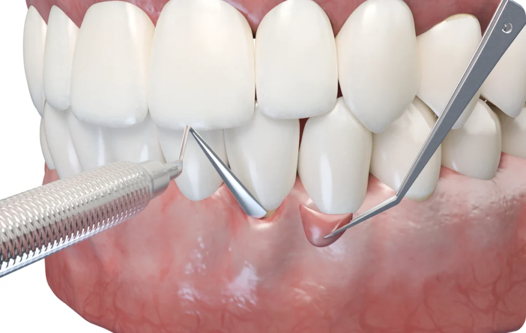 Greffe gingivale Immersion dentaire, Dentiste à Carnac