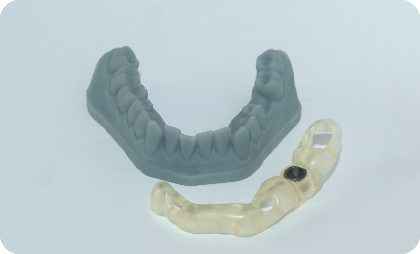 Implant dentaire à Carnac Immersion dentaire, Dentiste à Carnac