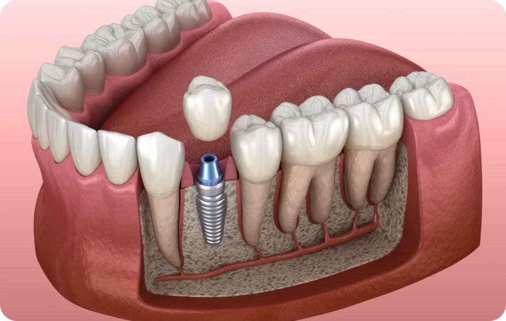 Implant dentaire à Carnac Immersion dentaire, Dentiste à Carnac
