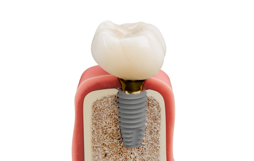 Implant dentaire à Carnac Immersion dentaire, Dentiste à Carnac