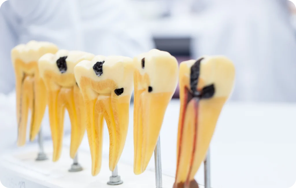 Inlay / Onlay à Carnac Immersion dentaire, Dentiste à Carnac