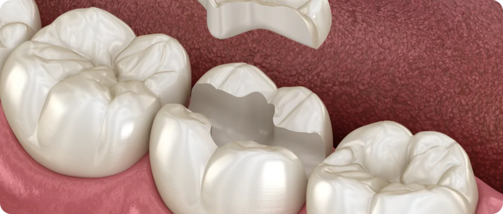 Inlay / Onlay à Carnac Immersion dentaire, Dentiste à Carnac