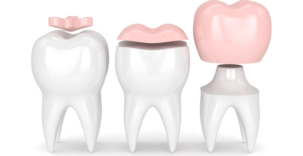 Inlay / Onlay à Carnac Immersion dentaire, Dentiste à Carnac