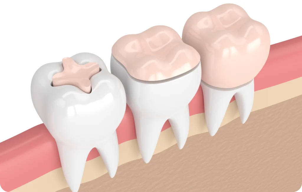 Inlay / Onlay à Carnac Immersion dentaire, Dentiste à Carnac