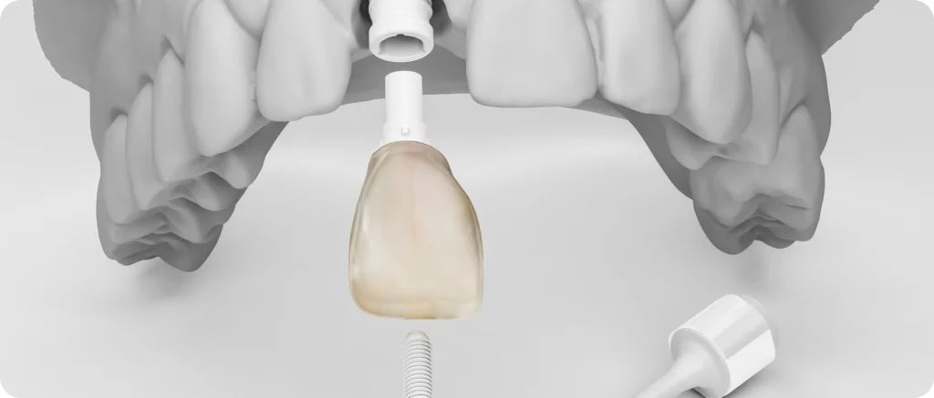 Implant dentaire à Carnac Immersion dentaire, Dentiste à Carnac