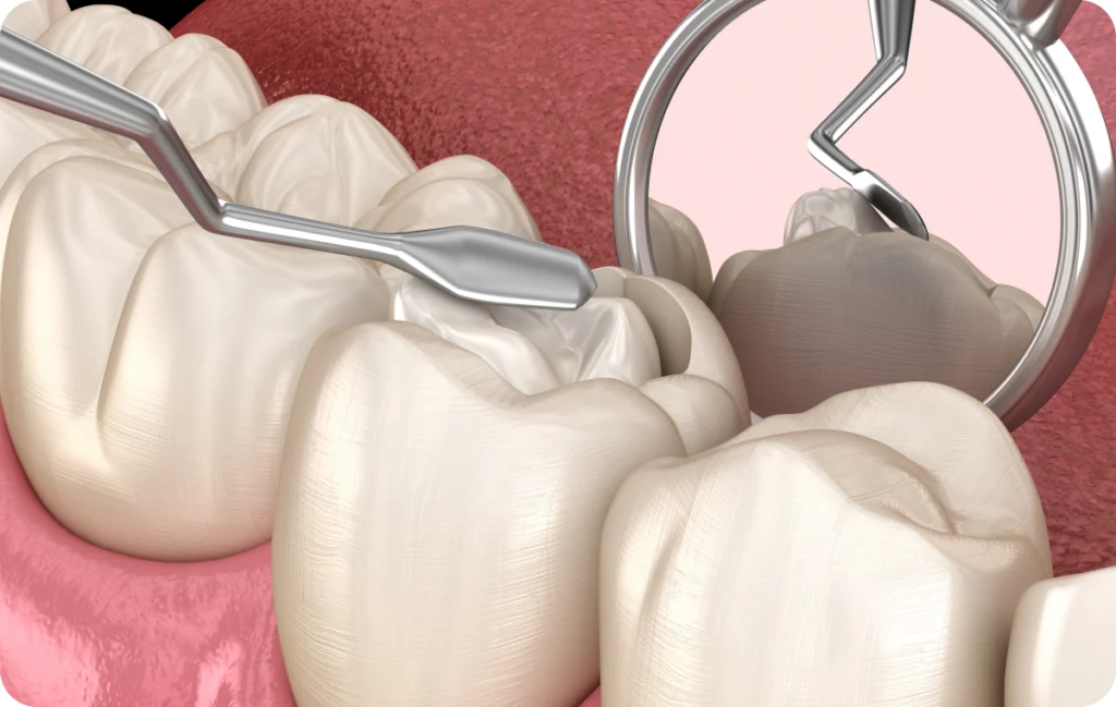 Soins courants en composite Immersion dentaire, Dentiste à Carnac