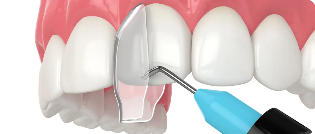 Composites esthétiques & composites injectés Immersion dentaire, Dentiste à Carnac