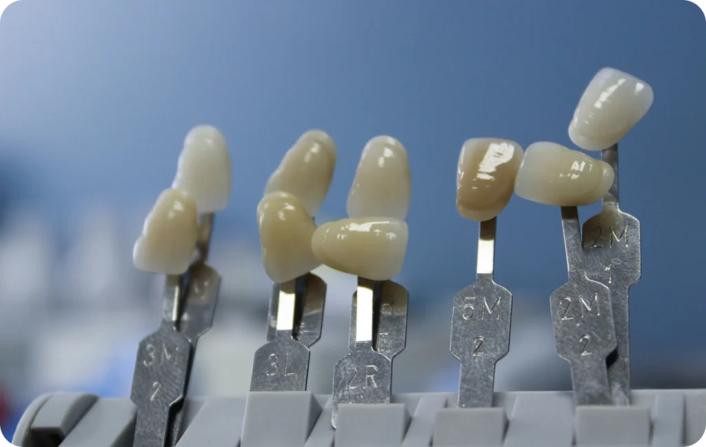 Composites esthétiques & composites injectés Immersion dentaire, Dentiste à Carnac