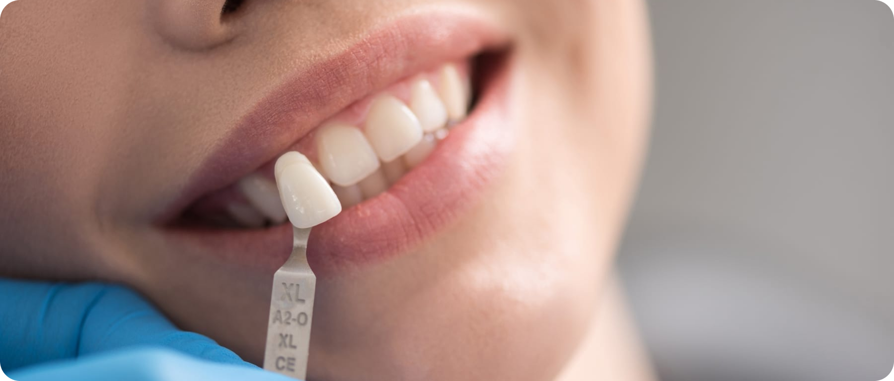 Composites esthétiques ; composites injectés, Immersion dentaire, Dentiste à Carnac