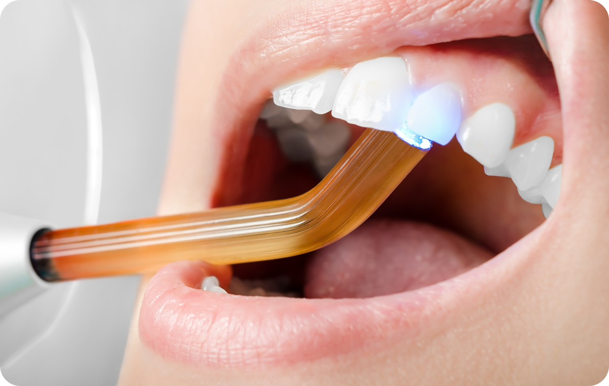 Soins courants en composite, Immersion dentaire, Dentiste à Carnac