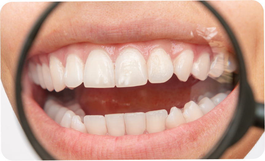 Traitement des tâches dentaires à Carnac Immersion dentaire, Dentiste à Carnac