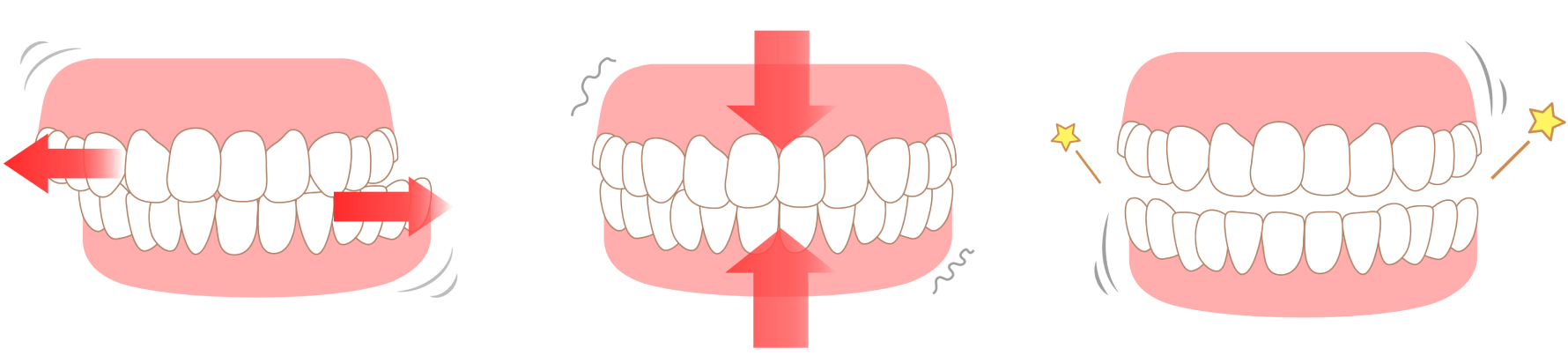 Bruxisme Immersion dentaire, Dentiste à Carnac