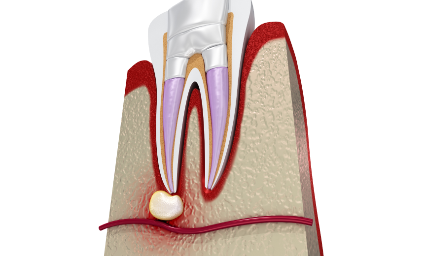 Retraitement endodontique Immersion dentaire, Dentiste à Carnac