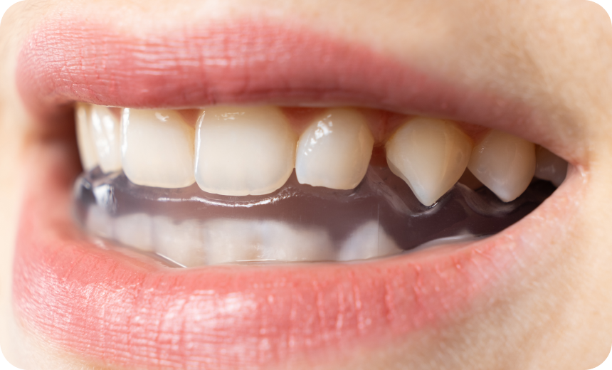 Bruxisme Immersion dentaire, Dentiste à Carnac