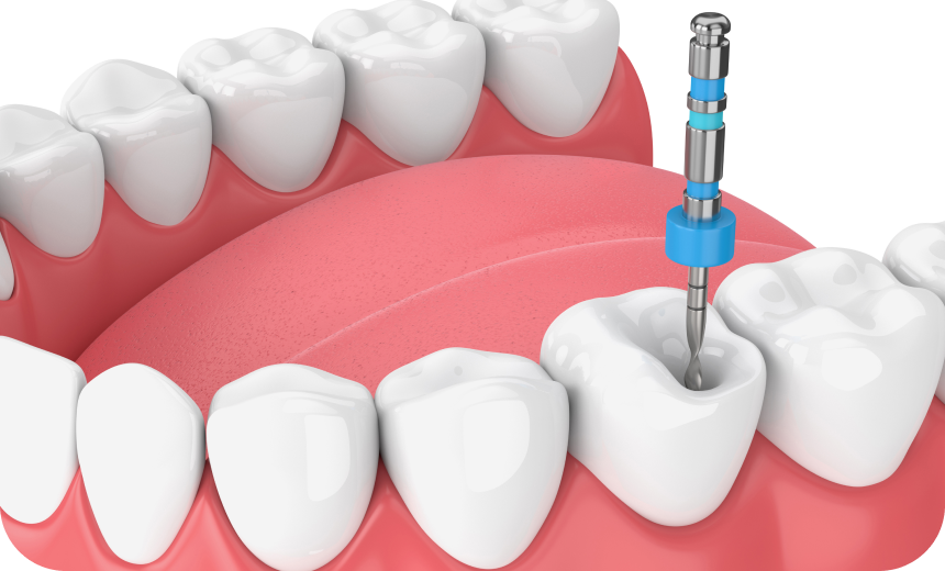 Retraitement endodontique Immersion dentaire, Dentiste à Carnac