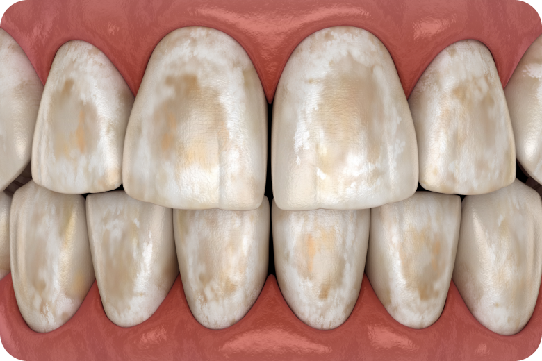Traitement des tâches dentaires à Carnac Immersion dentaire, Dentiste à Carnac