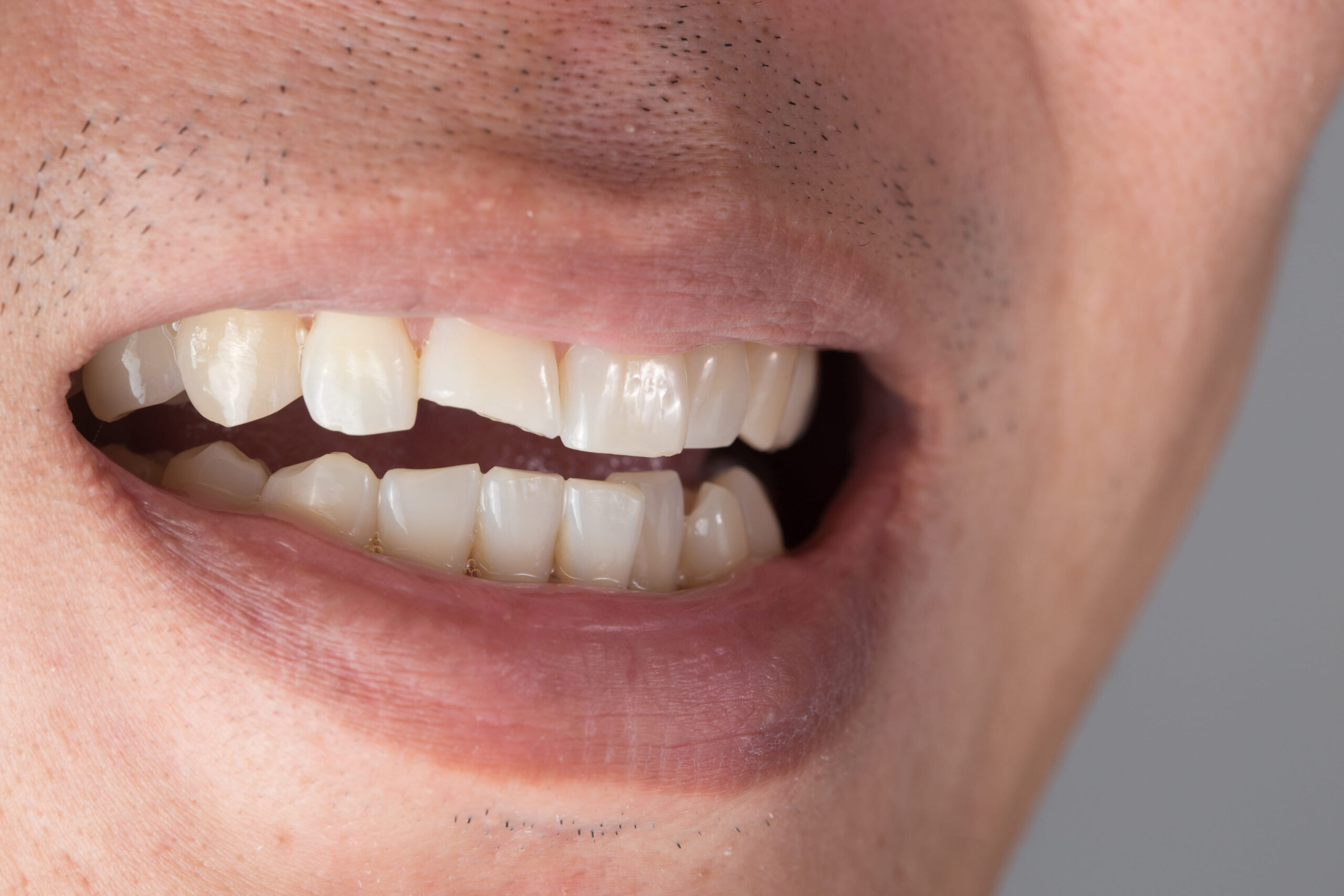 Vos besoins Immersion dentaire, Dentiste à Carnac