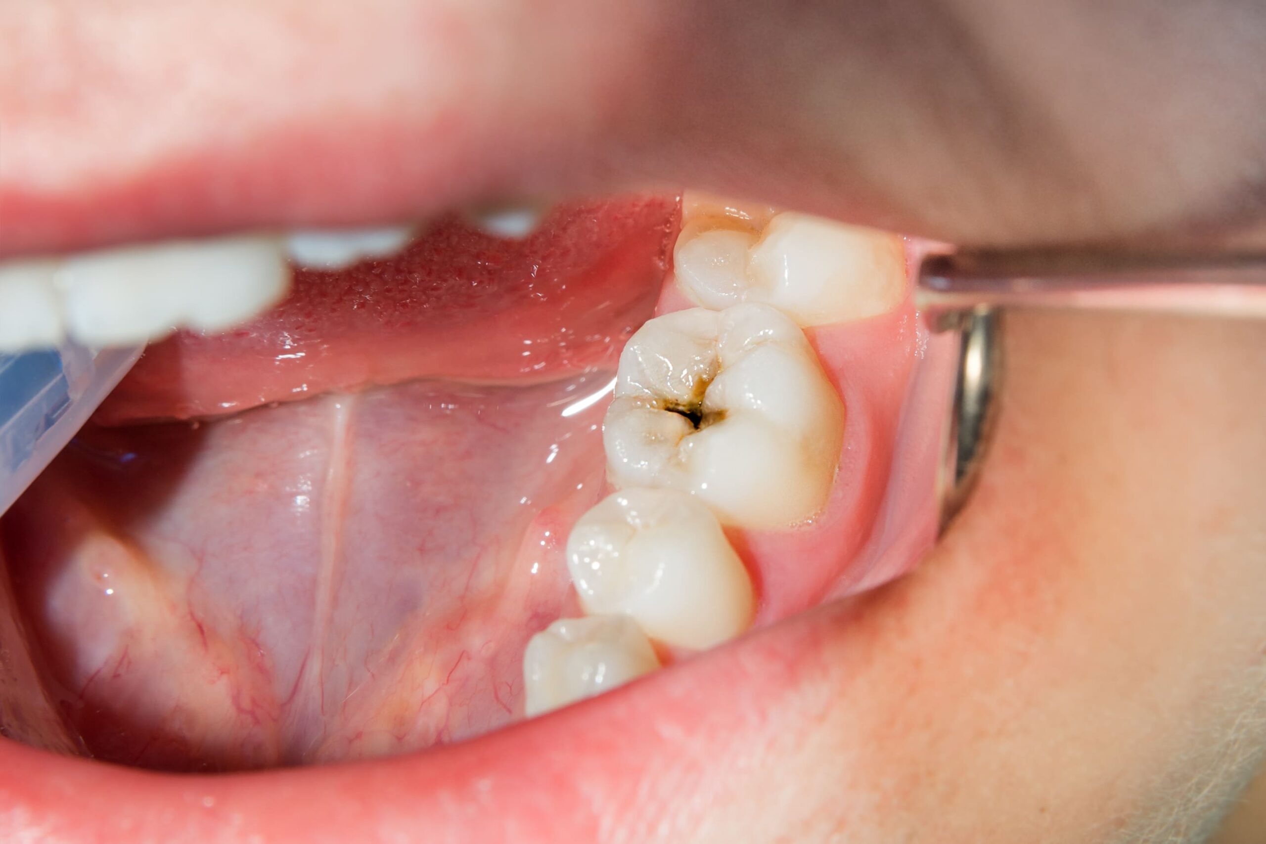 Vos besoins Immersion dentaire, Dentiste à Carnac