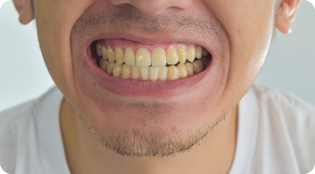 Vos besoins Immersion dentaire, Dentiste à Carnac